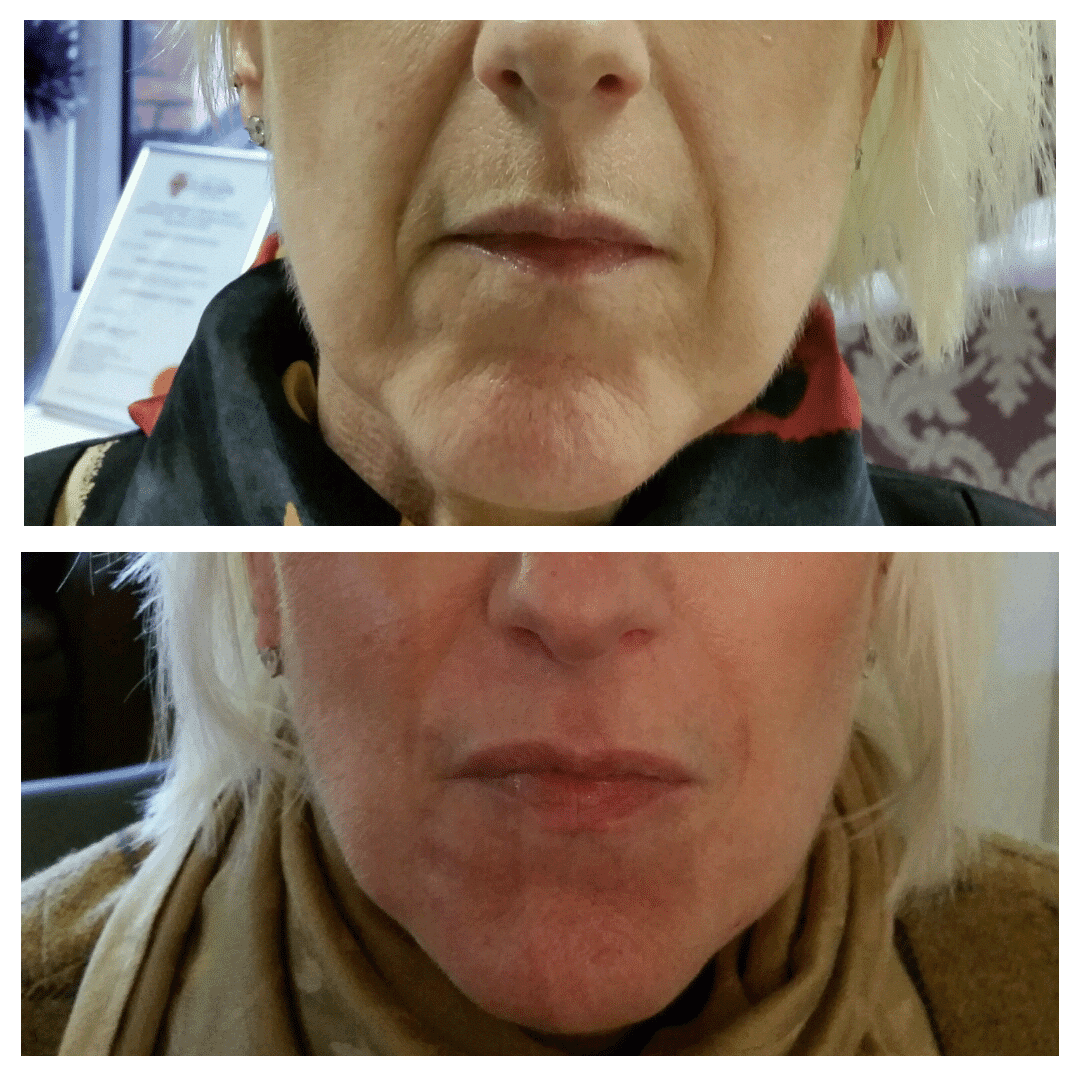Before and after dermal filler treatment results showing a reduction in wrinkles on a female patients face