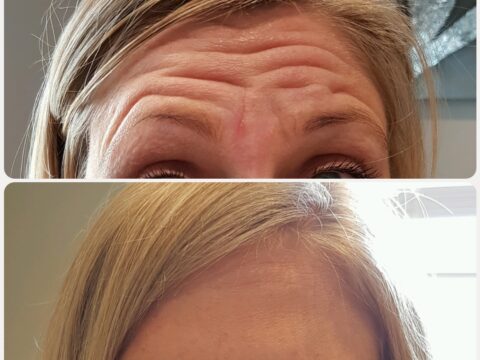 A before and after of botox treatments around the forehead and brows.