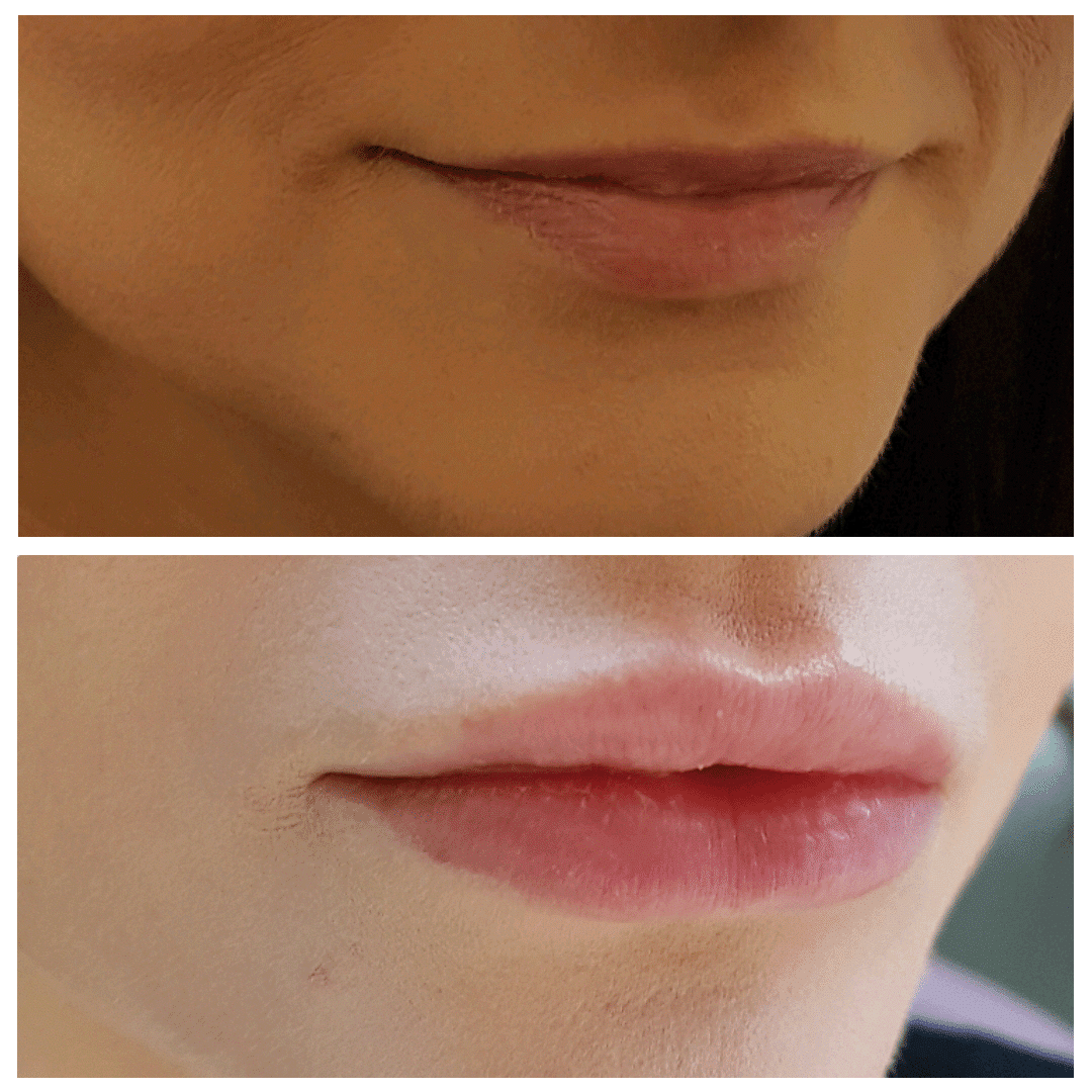 Before and after dermal filler treatment results showing larger more plump lips