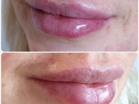 Before and after of lip treatments.