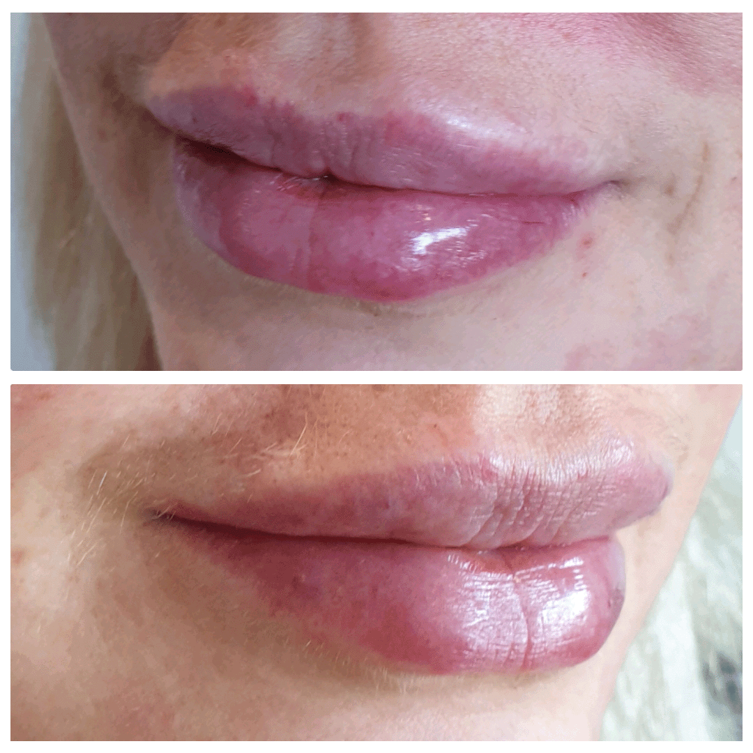 Before and after lip filler treatment results showing larger more plump lips