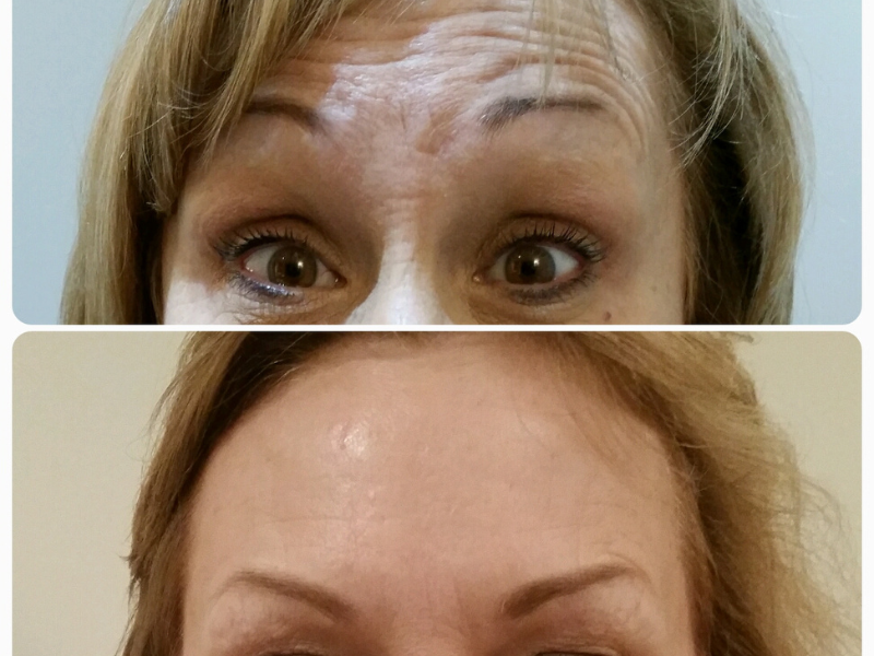 Before and after anti wrinkle treatment results showing a reduction in wrinkles on a female patients forehead