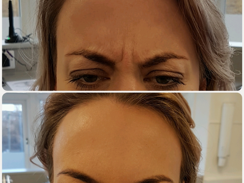 Before and after anti-wrinkle treatment results showing a reduction in wrinkles on a female patients forehead
