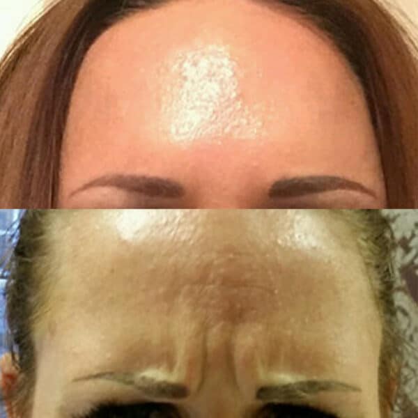 Before and after of botox treatments around the forehead.