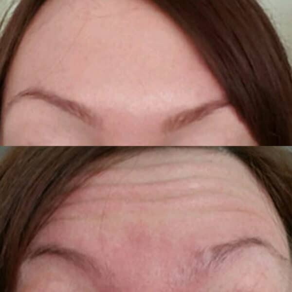 Before and after of botox treatments around the forehead.