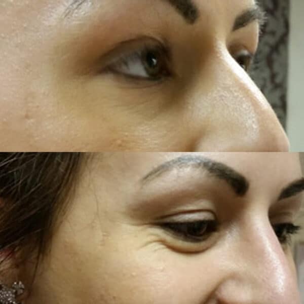 Before and after of botox treatments around the eyes.