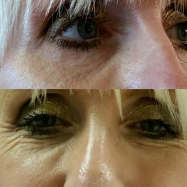 Before and after of botox treatments around the eyes.