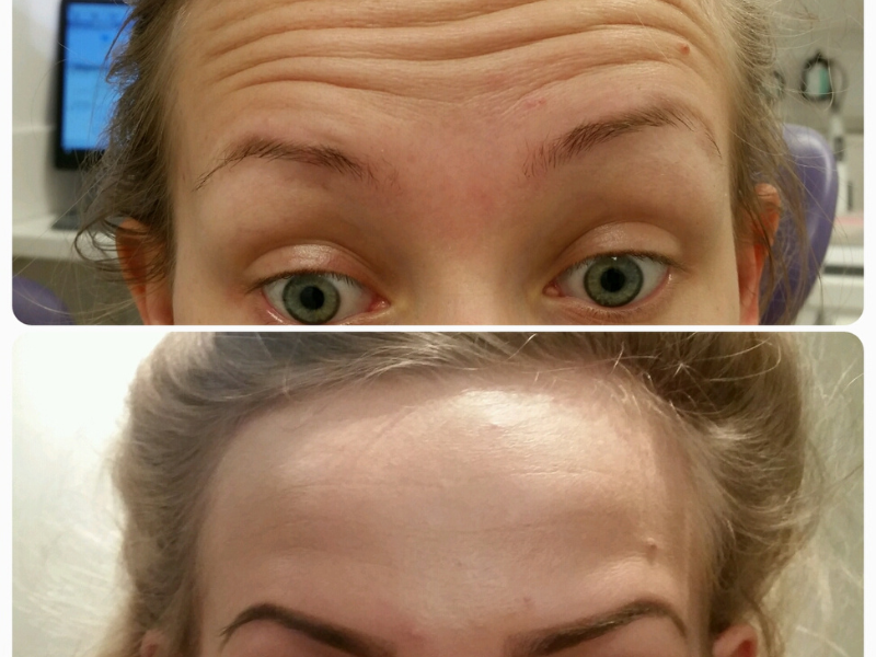 Before and after anti wrinkle treatment results showing a reduction in wrinkles on a female patients forehead