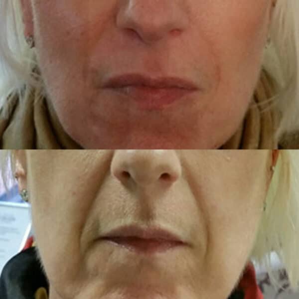 Before and after of dermal fillers.