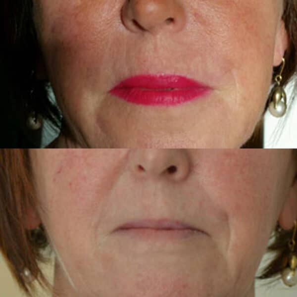 Before and after of dermal fillers.