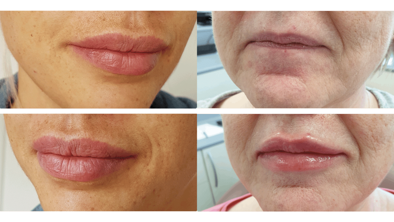 Before and after results of dermal filler treatment showing larger more plump lips