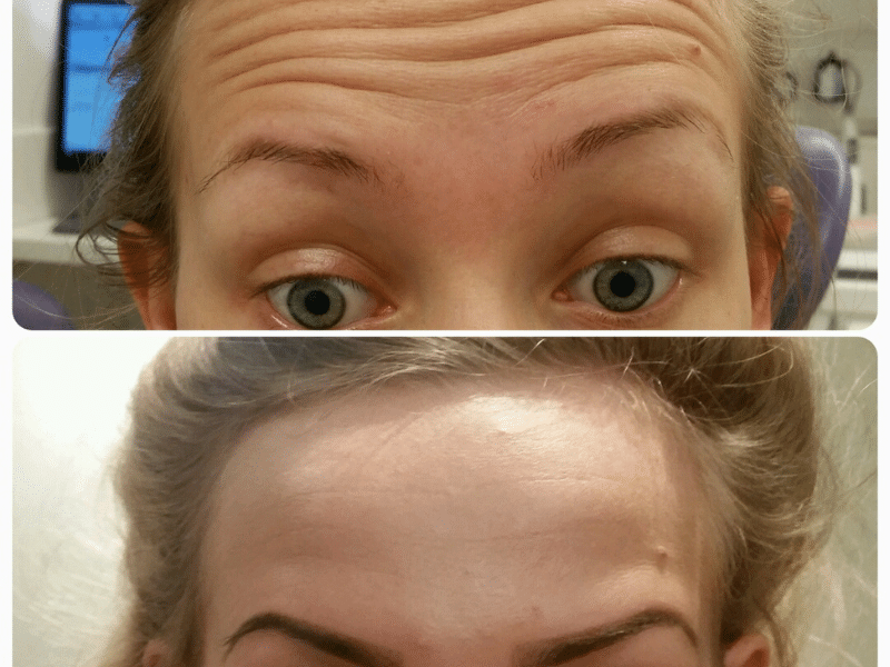 Before and after results of facial rejuvenation treatment showing a reduction in wrinkles on the forehead