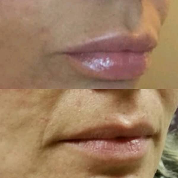 Before and after of lip fillers.