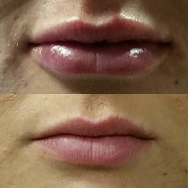 Before and after of lip fillers.