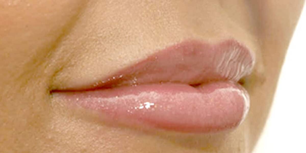 Results of lip fillers showing large plump lips