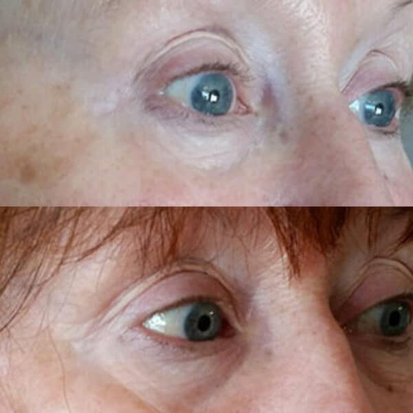 Before and after of tear trough fillers.